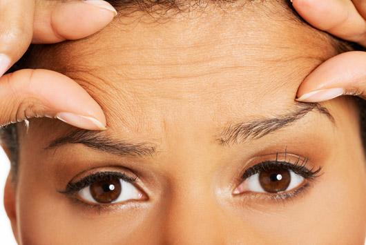 Toxine botulique et migraine