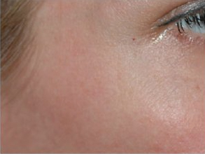 After-Avant / Après Injection