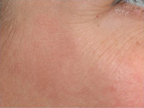 Before-Avant / Après Injection