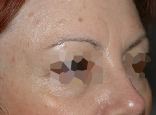 After-Toxine botulique - Front et yeux