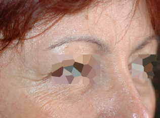 Before-Toxine botulique - Front et yeux