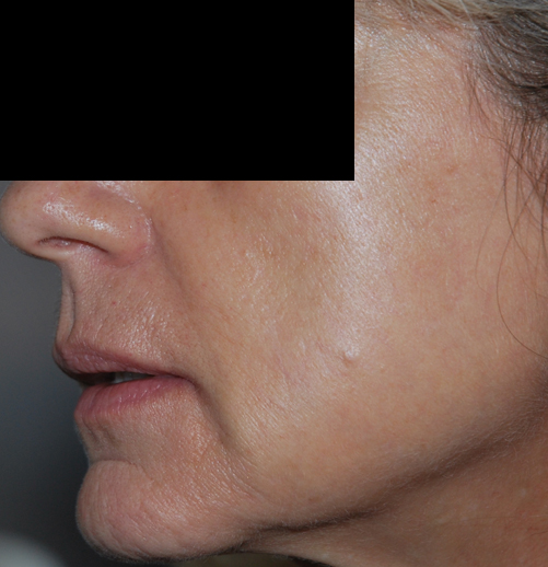 After-Laser CO2 fractionné 