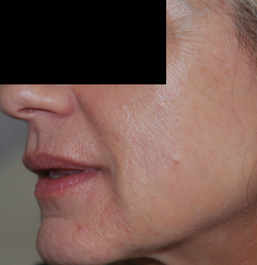 Before-Laser CO2 fractionné 