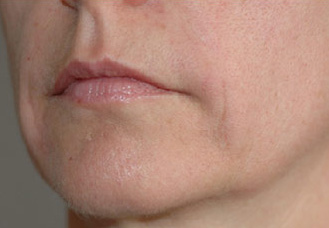 After-Sillons nasogéniens - pli d\'amertume