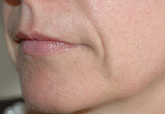 Before-Sillons nasogéniens - pli d\'amertume