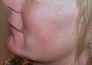 After-Acide hyaluronique - Volume joues
