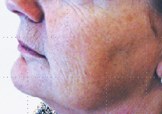 Before-Acide hyaluronique - Volume joues