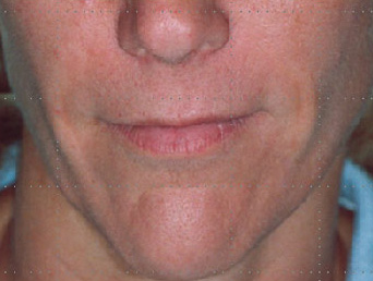 After-Acide hyaluronique - Sillons naso-géniens