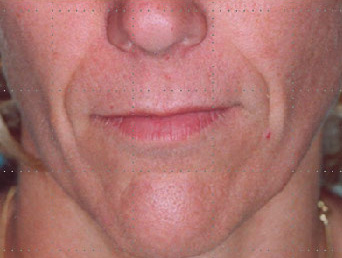 Before-Acide hyaluronique - Sillons naso-géniens