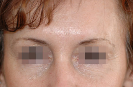 After-Avant / Après Injection de Toxine Botulique