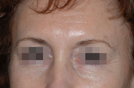 Before-Avant / Après Injection de Toxine Botulique