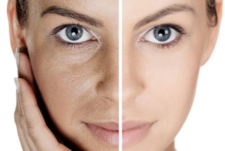 Laser CO² fractionné